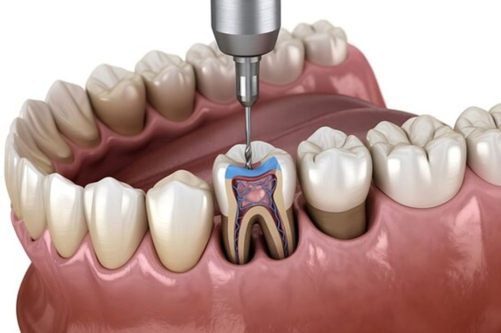 Root Canal Treatment